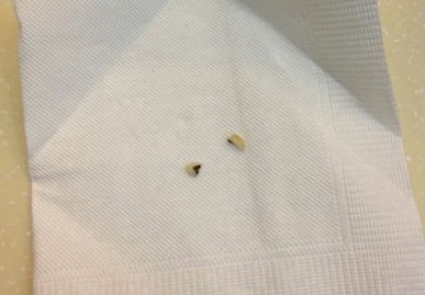 青島萬(wàn)和春就餐硌掉烤瓷牙 店方被指滅證